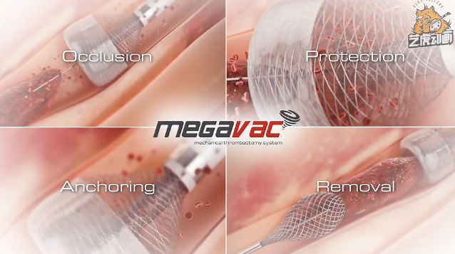 醫(yī)學(xué)醫(yī)療動畫 醫(yī)學(xué)醫(yī)療動畫