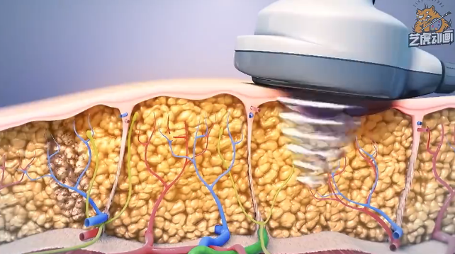 醫療動畫 醫療動畫