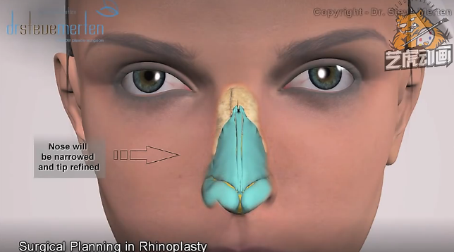 醫療演示三維動畫 醫療演示三維動畫