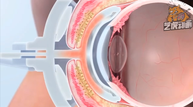 醫(yī)學(xué)三維動畫 醫(yī)學(xué)三維動畫