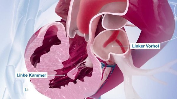 心臟手術醫學醫療動畫 心臟手術醫學醫療動畫